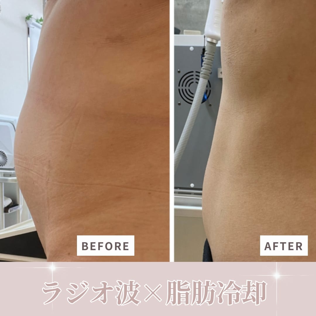 脂肪冷却（お腹）施術のビフォーアフター例1