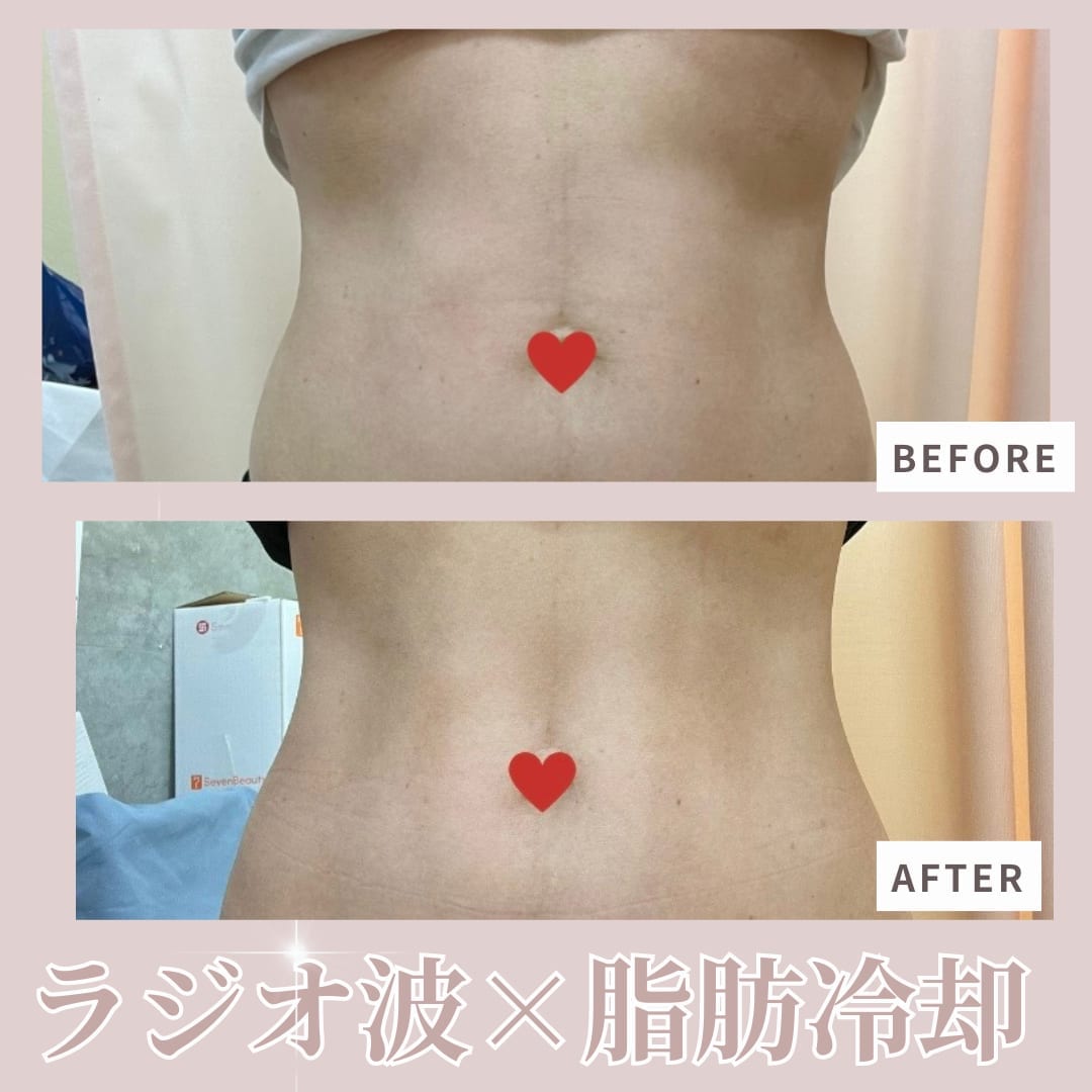 脂肪冷却（お腹）施術のビフォーアフター例2