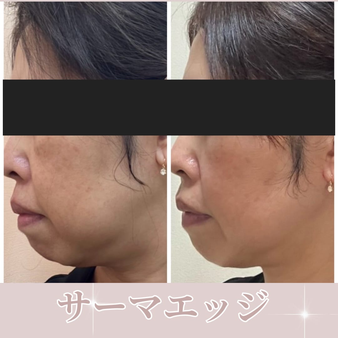 サーマルフラクショナル施術のビフォーアフター例1